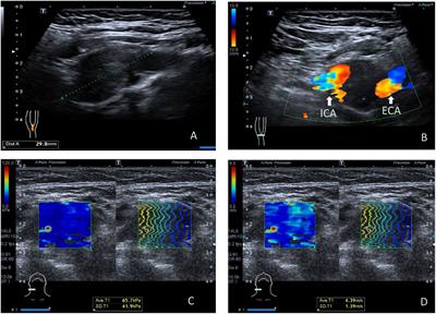 Application of the shear wave elastography in the assessment of carotid body tumors: A preliminary study